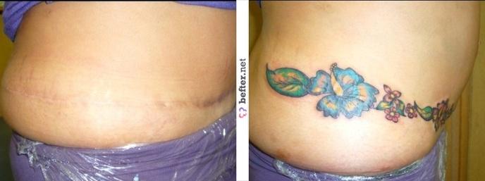 tatouage cicatrice ventre