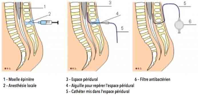 tatouage dos péridurale