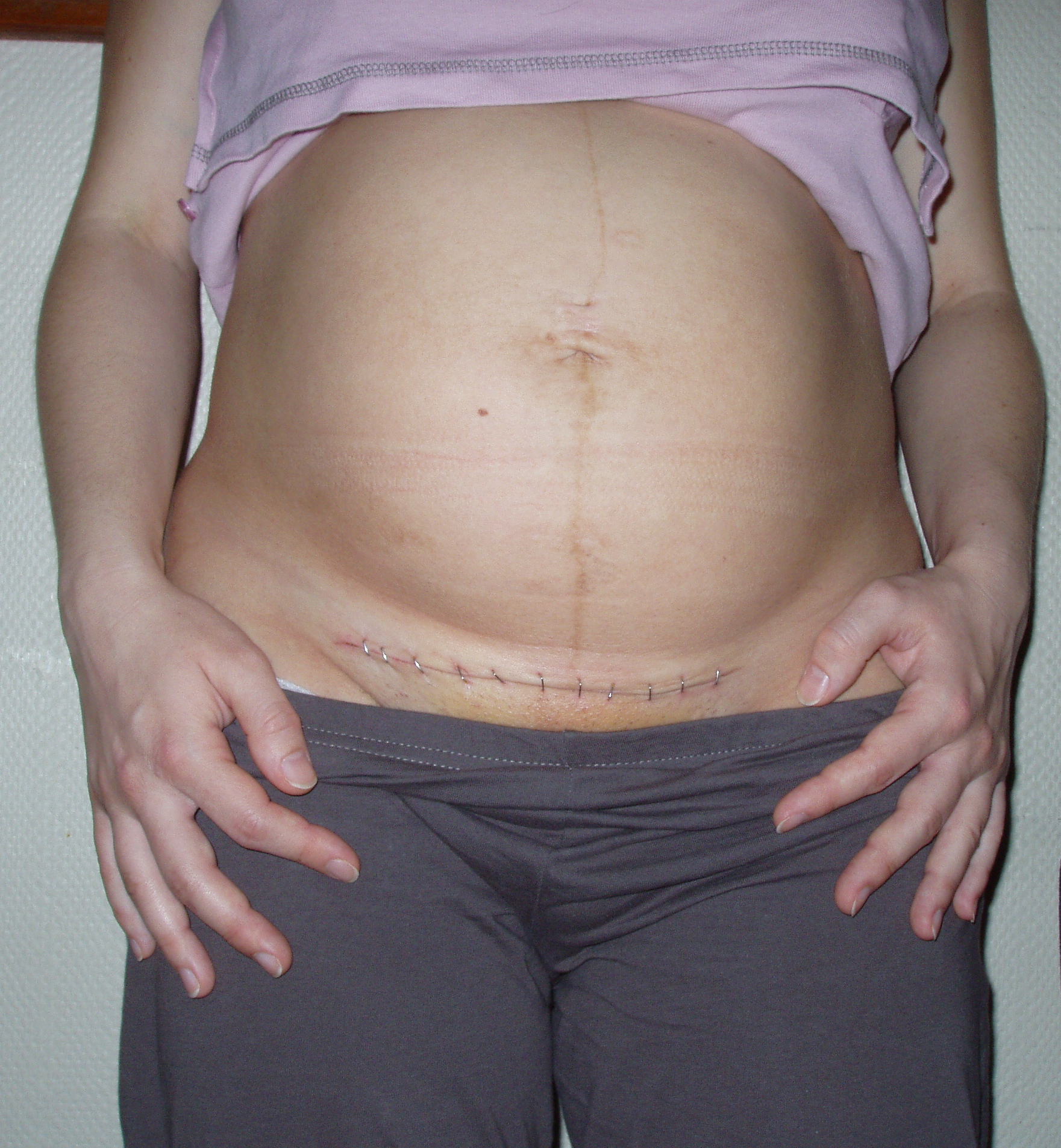 tatouage ventre cesarienne