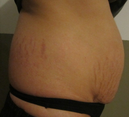 tatouage ventre cesarienne